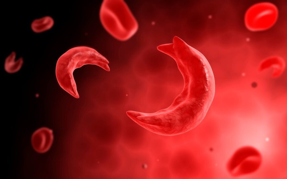 ABC of Sickle Cell Pain Crisis